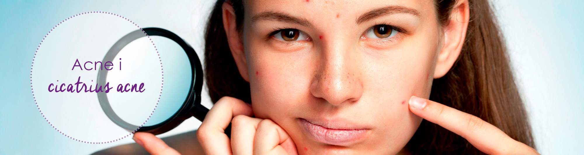 acne, marcas acne, marques acne, cicatrius acne, cicatrius, acné, acne andorra
