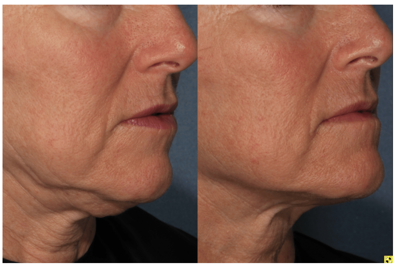 BTL Exilis Elite TM radiofréquence médicale et ultrasons DermAndTek Dermatologia Andorra BTL Exilis Elite TM radiofréquence médicale et ultrasons DermAndTek Dermatologia Andorra