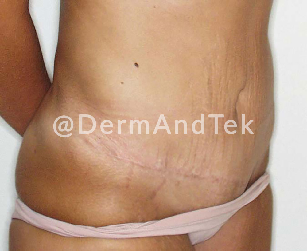 abdominoplastia, reduccion abdomen mujer, operació abdomen, reduccio abdomen, abdomen dona