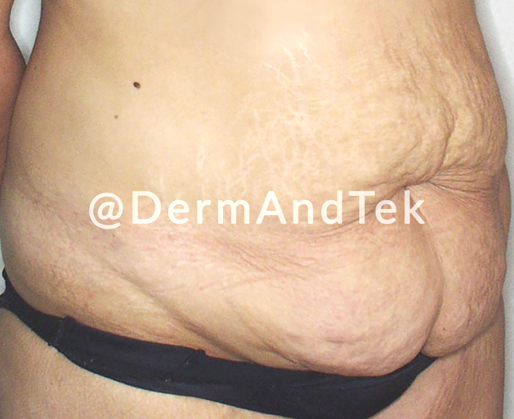 abdominoplastia, reduccion abdomen mujer, operació abdomen, reduccio abdomen, abdomen dona