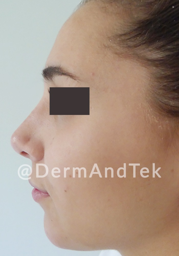 rinoplastia-despues-andorra RHINOPLASTIE, rinoplastia despues andorra, rinoplastia andorra, operació nas, operación nariz, resultado rinoplastia
