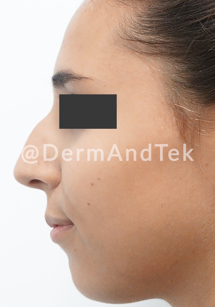 rinoplastia-nariz-antes-operacion RHINOPLASTY, rinoplastia antes andorra, rinoplastia andorra, operació nas, operación nariz